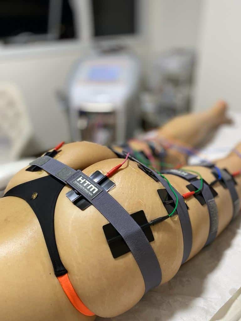 Aplicação de corrente russa em atendimento corporal